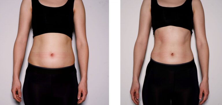 CryoTone Abdomen Before and After