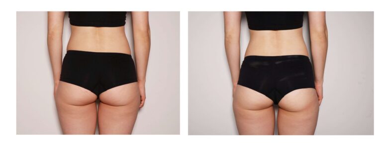 CryoTone Buttocks Before and After