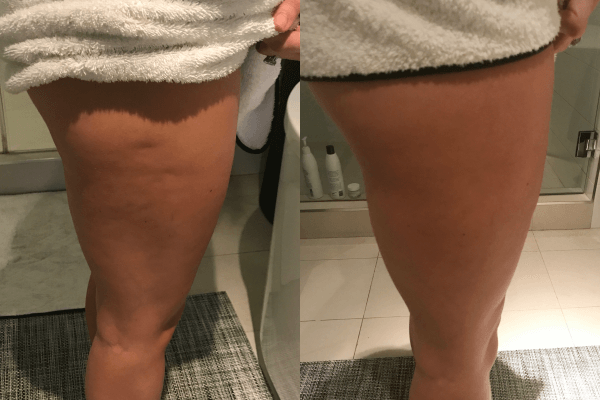 CryoTone Legs Before and After