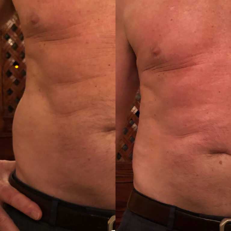 Love Handles Before After