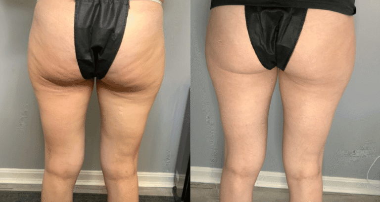 CryoTone Legs Before and After