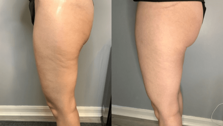 CryoTone Legs Before and After