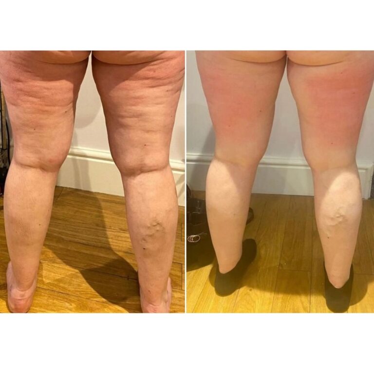 CryoTone Legs Before and After