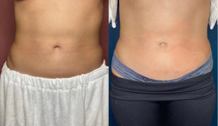 CryoSlim after 2 session